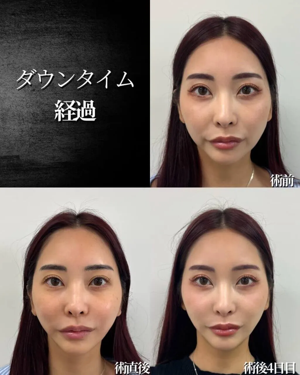 糸リフトの症例