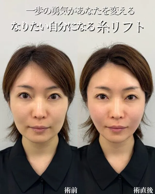 糸リフトの症例