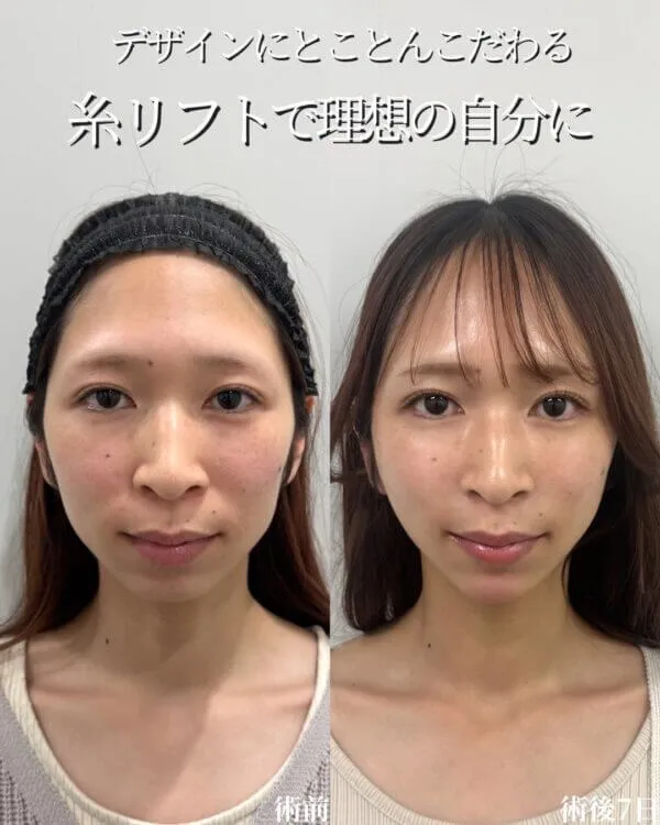糸リフトの症例