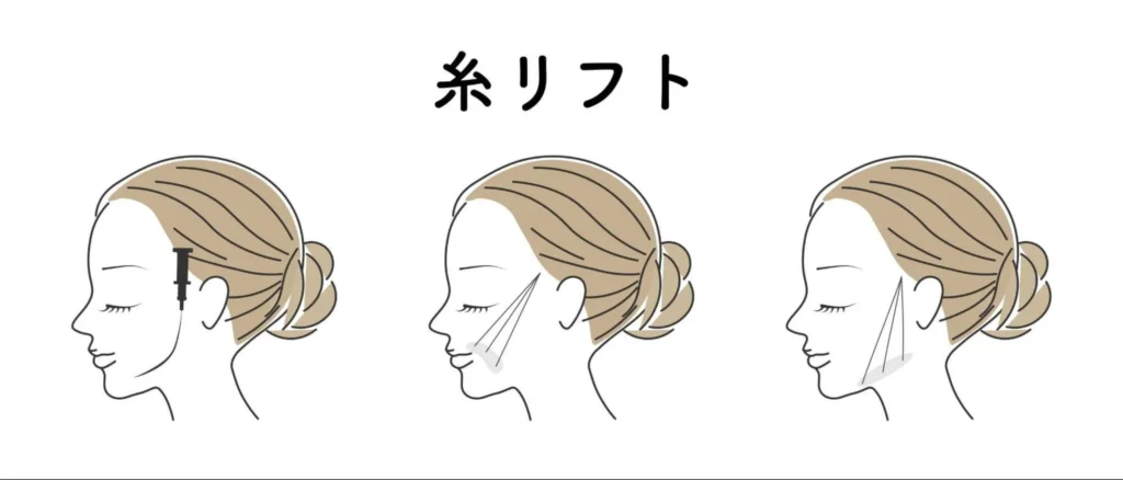 糸リフトの施術