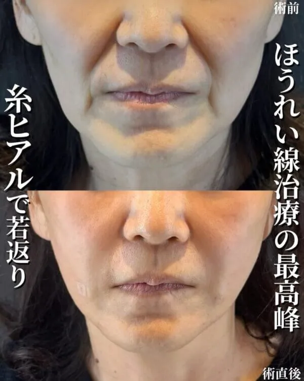 糸リフトの症例