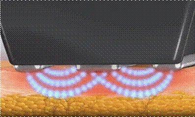 インモード施術