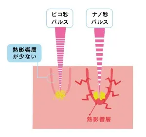ピコレーザー施術