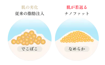 脂肪注入施術